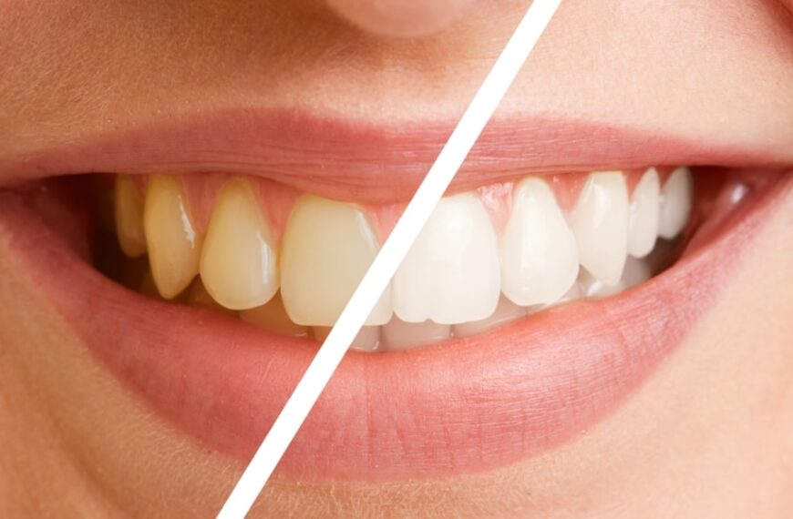 Comment nettoyer les dents jaunes : 5 conseils et méthodes pour retrouver un sourire éclatant